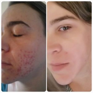 acne compare 1