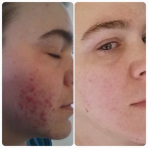 acne compare 2